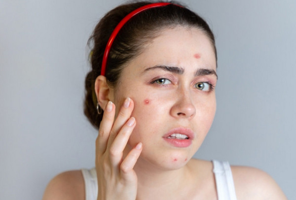 Isotretinoin nên uống buổi sáng hay tối? Trước hay sau ăn?