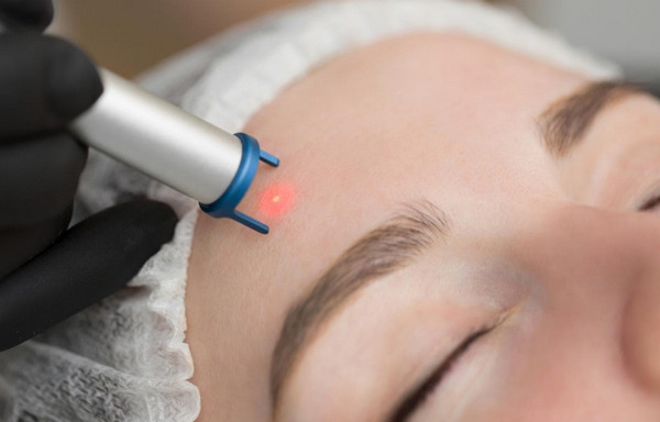 Laser trị mụn như thế nào? Công nghệ nổi bật và lưu ý khi thực hiện