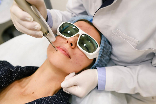 Laser trị mụn như thế nào? Công nghệ nổi bật và lưu ý khi thực hiện