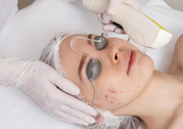 Laser trị mụn như thế nào? Công nghệ nổi bật và lưu ý khi thực hiện