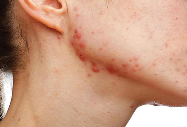 Ngưng isotretinoin đột ngột có sao không?