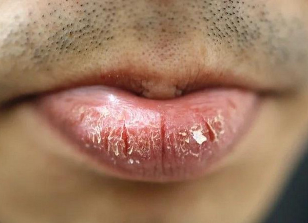 Uống iso bị khô môi là bình thường hay bất thường? Các chăm sóc