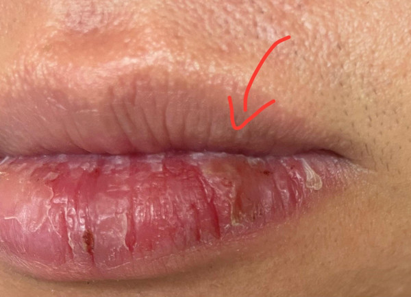 Uống iso bị khô môi là bình thường hay bất thường? Các chăm sóc